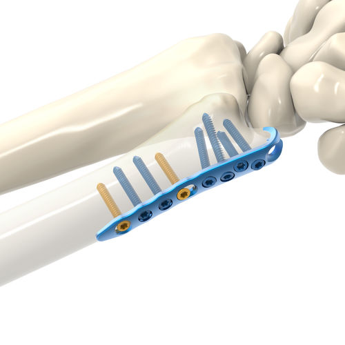 Kompressionsplatte für Ulna - ARIX 2.0 - Jeil Medical Corporation - distal / mit Verriegelung / Titan