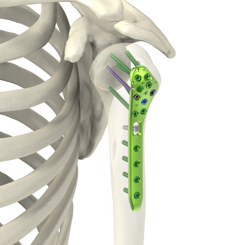 Kompressionsplatte für Humerus - Jeil Medical Corporation - proximal / mit Verriegelung / Titan