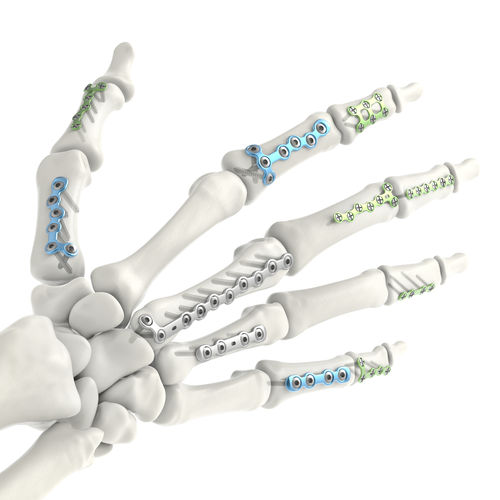 Kompressionsplatte für Fingerglied - Jeil Medical Corporation - für Mittelhandknochen / mit Verriegelung / Titan