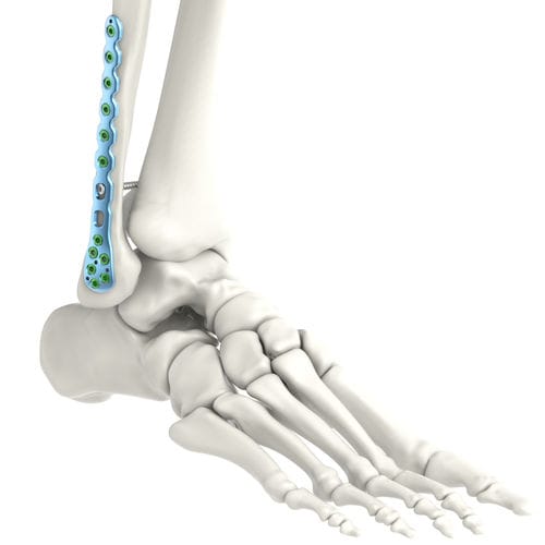 Kompressionsplatte für Fibula - Jeil Medical Corporation - distal / seitlich / mit Verriegelung