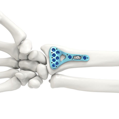 Kompressionsplatte für Radius - ARIX 2.5 - Jeil Medical Corporation - distal / mit Verriegelung / Titan