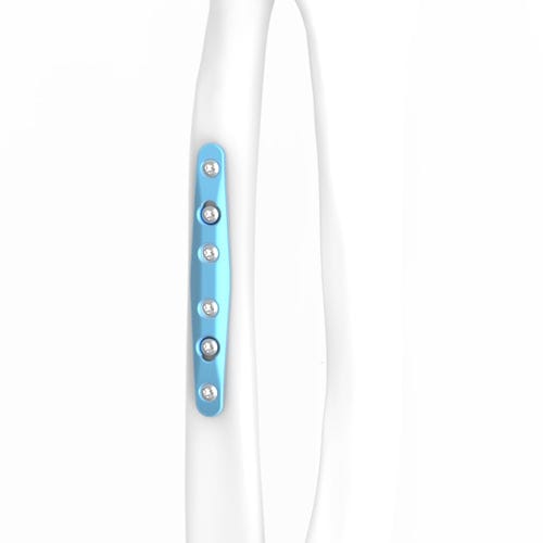 Osteotomieplatte für Ulna - ARIX 2.8 - Jeil Medical Corporation - medial / mit Verriegelung / Titan