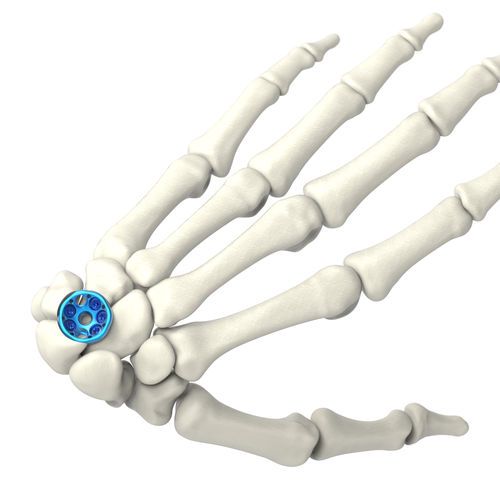 Arthrodeseplatte für Handwurzelknochen - ARIX 2.5 - Jeil Medical Corporation - mit Verriegelung / Titan