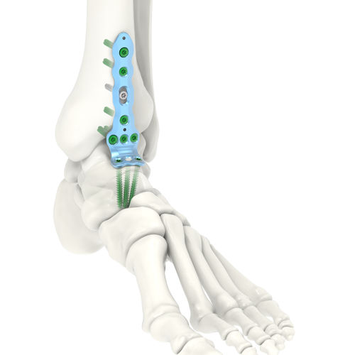 Arthrodeseplatte für Knöchel - ARIX 3.5 - Jeil Medical Corporation - distal / medial / mit Verriegelung