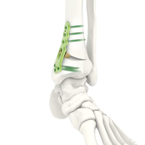 Osteotomieplatte für Tibia - ARIX 3.5 - Jeil Medical Corporation - distal / mit Verriegelung / Titan