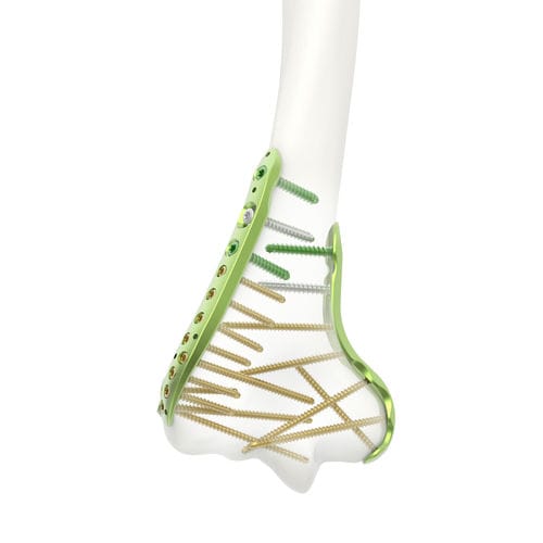 Kompressionsplatte für Humerus - Jeil Medical Corporation - distal / mit Verriegelung / Titan
