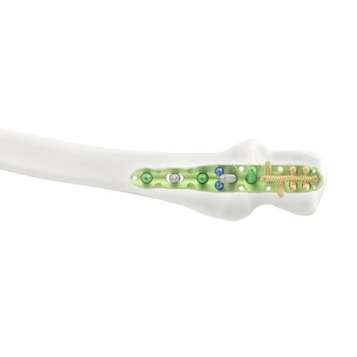Kompressionsplatte für Olekranon - Jeil Medical Corporation - proximal / mit Verriegelung / Titan