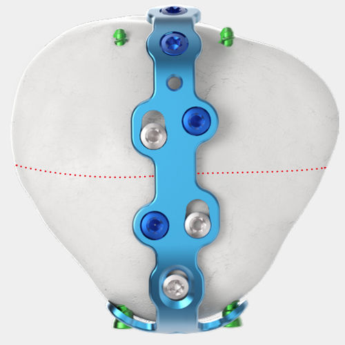 Kompressionsplatte für Patella - Jeil Medical Corporation - mit Verriegelung / Titan