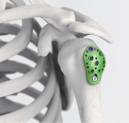 Kompressionsplatte für Humerus - ARIX 3.5 - Jeil Medical Corporation - proximal / mit Verriegelung / Titan