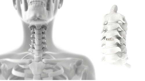 HWS-Zwischenwirbelimplantat - FIX-C - Jeil Medical Corporation - ventraler Zugang / aus PEEK