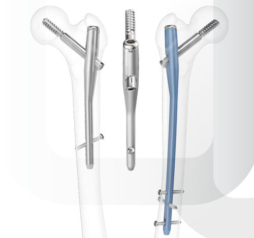 Marknagel für Oberschenkelknochen - ARIX - Jeil Medical Corporation - mit proximaler Fixierung / mit diaphysärer Fixierung / rechts
