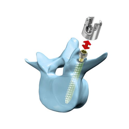 LWS-Pedikelschraube - “mediRod®”-Tri - Medicon eG - polyaxial / kanüliert