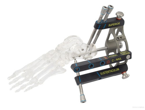 Marknagel für Calcaneum - C-NAIL - MEDIN