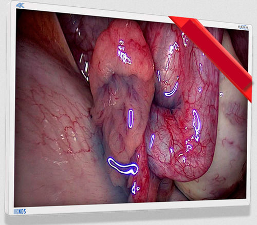Medizinisch Monitor - EndoVue Plus - NDS Surgical Imaging - für Endoskopie / hochauflösend / 55"