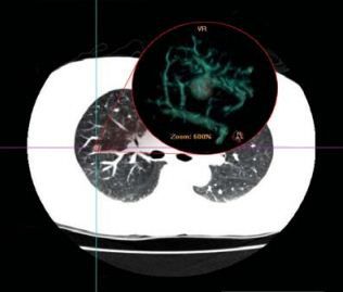 Analysesoftware - NeuLungCARE - Neusoft Medical Systems  - Visualisierung / Mess / CAD