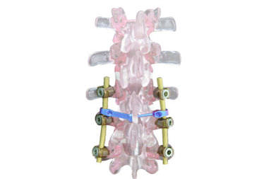 Zerviko-maxillo-lumbo-sacrales Stabilisierungssystem für Osteosynthese - EVOLUTION PLUS - Ortosintese - dorsaler Zugang / für Erwachsene