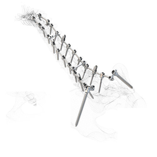 Polyaxiale Pedikelschraube - WSI MX/PX®  - Peter Brehm - monoaxial / Metall