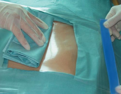 OP-Feld / für Allgemeinchirurgie - Incifilm® - Pharmaplast - für orthopädische Chirurgie / für die Herzchirurgie / für Augenchirurgie