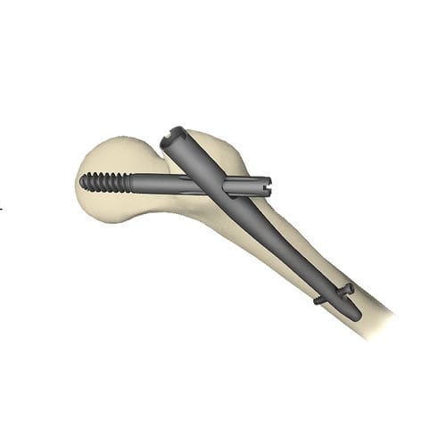Marknagel für Oberschenkelknochen - Gamma3 - Stryker - für Trochanter / mit proximaler Fixierung / Titan