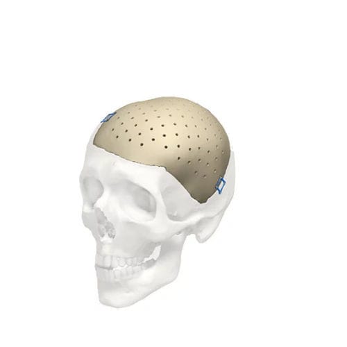 Patientenspezifisches Schädelimplantat - Cranial iD - Stryker