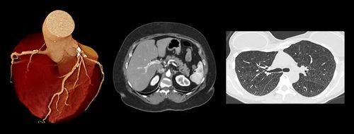 Medizinische Software - PIQE - Canon Medical Systems Europe - Computertomographie / Visualisierung / Diagnose
