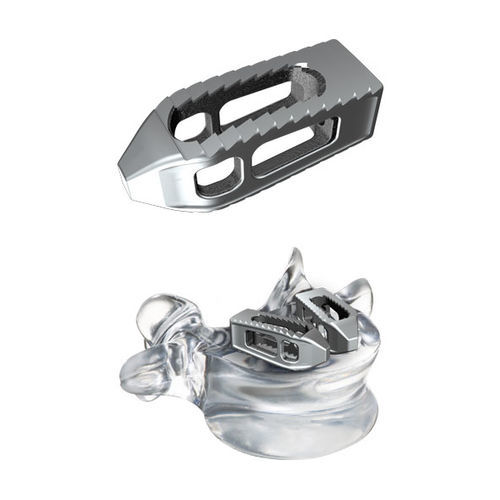 Lumbal-Sakral-Zwischenwirbelimplantat - tezo™ - ulrich medical - transforaminaler Zugang / Titan