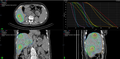 Umform-Software - RapidSphere - Varian Oncology - überwacht / Modellierung / Konturierung