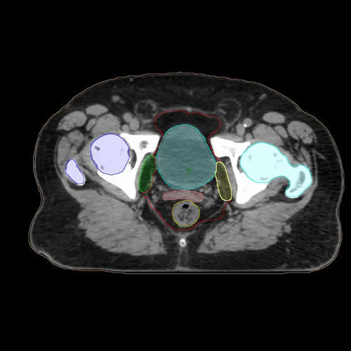 Medizinische KI-Plattform - Varian Oncology - Konturierung / Behandlungsplanung