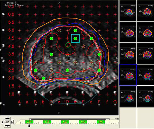 Visualisierungssoftware - VariSeed™  - Varian Oncology - Behandlungsplanung / Import / medizinisch
