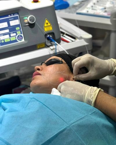 Hautverjüngungseinheit mit Laser - Endolifting - GIGAALASER - auf Wagen