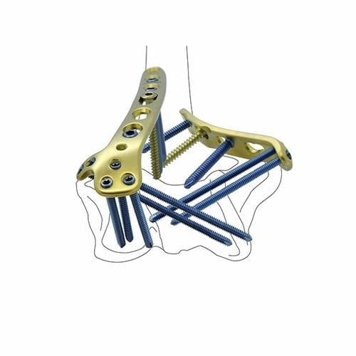 Kompressionsplatte für Humerus - Double Medical Technology - distal / medial / mit Verriegelung