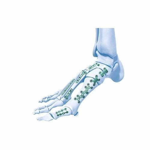 Kompressionsplatte für Metatarsalknochen - Double Medical Technology - für Zehenglied / für Tarsalknochen / mit Verriegelung