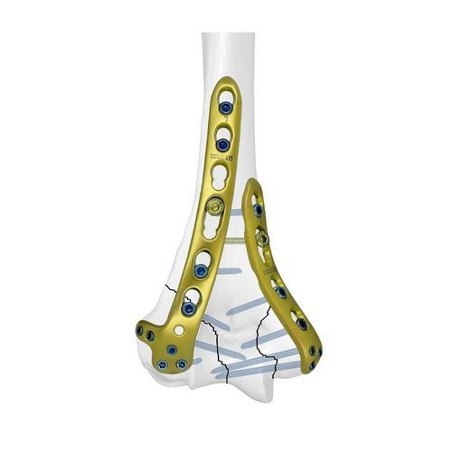 Kompressionsplatte für Humerus - Double Medical Technology - distal / mit Verriegelung