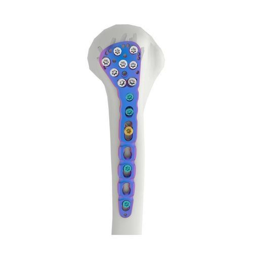 Kompressionsplatte für Humerus - VAL - Double Medical Technology - proximal / mit Verriegelung
