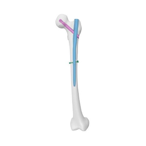 Marknagel für Oberschenkelknochen - APFN Aimstrong - Double Medical Technology - mit proximaler Fixierung / mit diaphysärer Fixierung / Edelstahl