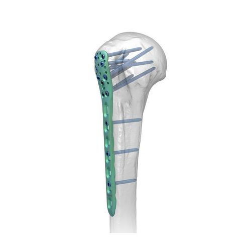 Kompressionsplatte für Humerus - PHL 2 - Double Medical Technology - proximal