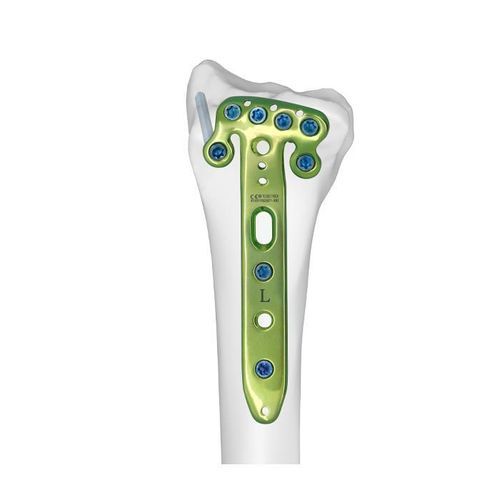 Kompressionsplatte für Radius - Double Medical Technology - distal / mit Verriegelung