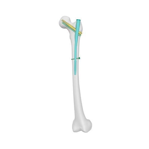 Marknagel für Oberschenkelknochen - PFCN - Double Medical Technology - mit proximaler Fixierung
