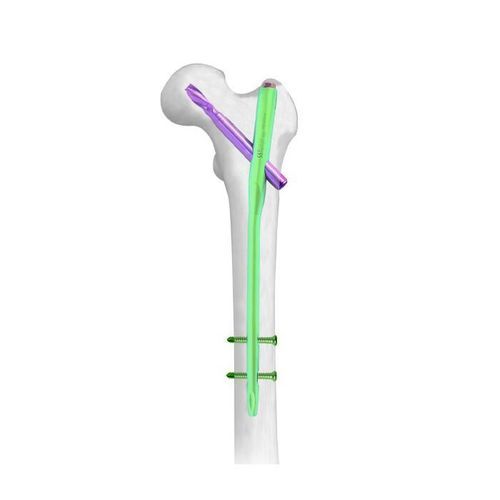Marknagel / für Oberschenkelknochen - PFNA - Double Medical Technology - für Oberschenkelknochen / mit proximaler Fixierung / mit distaler Fixierung