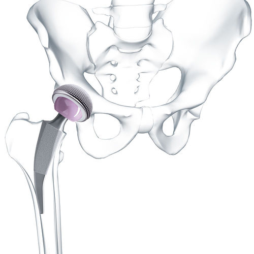 Minimalinvasive Hüftprothese - Metha®   - Aesculap® - zementfrei