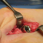 Implantat für Interphalangealgelenk des Fußes - HemiCAP DF®  - Arthrosurface
