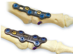 Arthrodeseplatte für Zehenglied - CheckMATE® - Arthrosurface - ohne Verriegelung / Metall