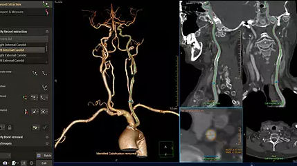 Analysesoftware - IntelliSpace Portal 12 - Philips Healthcare - Management / Visualisierung / Diagnose
