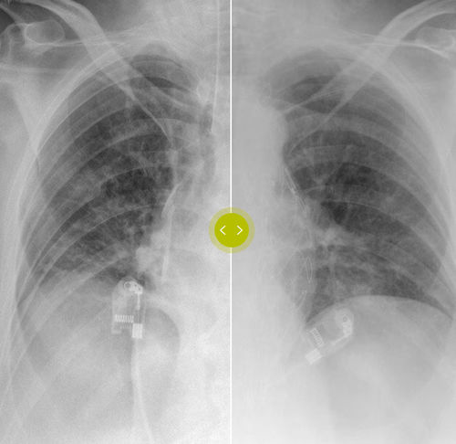 Beschaffungsalgorithmus - SkyFlow Plus - Philips Healthcare - Simulation / für maschinelles Lernen / Röntgen