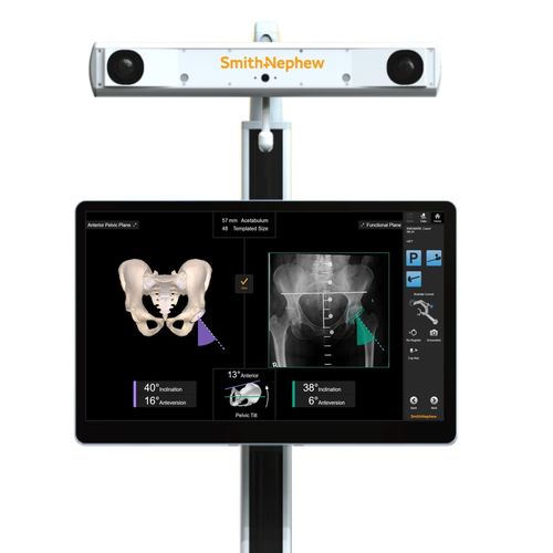 Chirurgisches Navigationssystem / zur Positionierung von Hüftprothesen - RI - Smith & Nephew - optisch