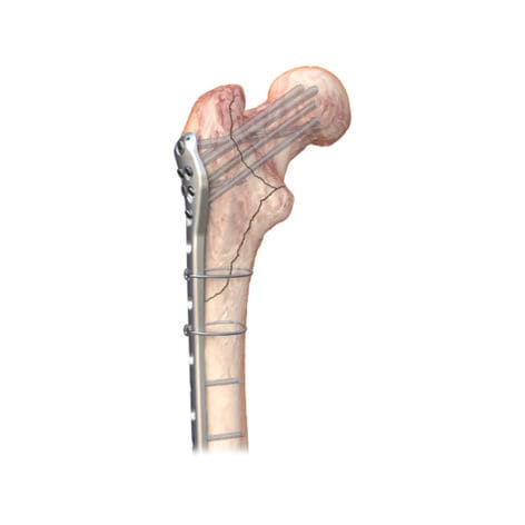 Kompressionsplatte für Oberschenkelknochen - PERI LOC PFP - Smith & Nephew - proximal / mit Verriegelung / Edelstahl