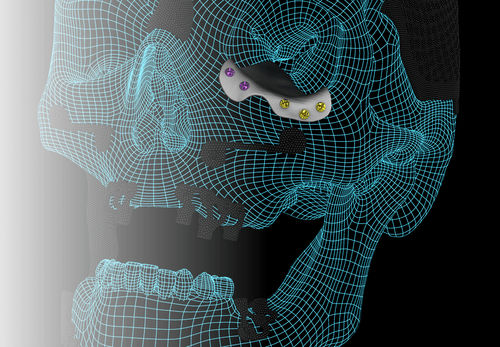 Patientenspezifisches Orbitalimplantat - ORBIT - A.B. Dental Devices