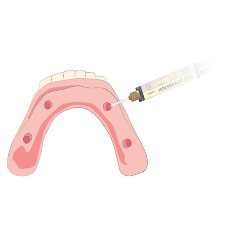 Dentalkleber für Implantatsysteme - retention.sil  - bredent medical - für Zahnprothesen
