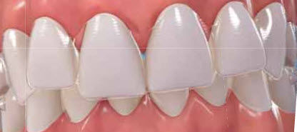 Aligner - Invisalign - Align Technology