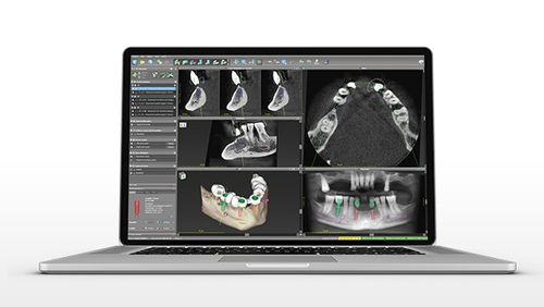 Software für Zahnchirurgie - coDiagnostiX - Dental Wings   - Dental / für Dentalimplantologie / Planung